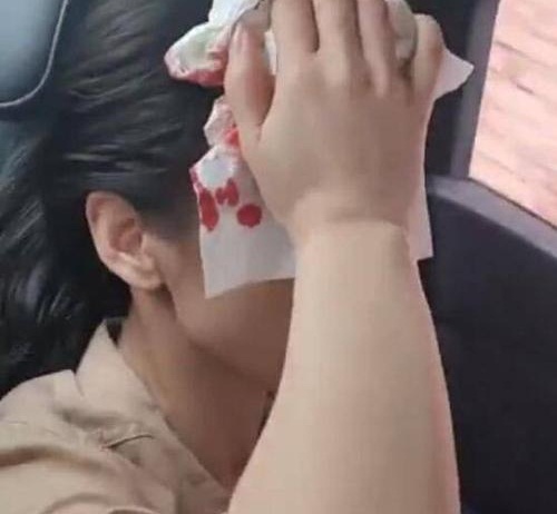 黄圣依拍戏时头部受伤,黄圣依拍戏被道具砸伤