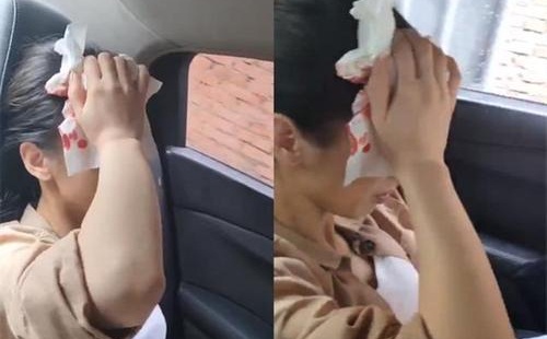 黄圣依拍戏头部受伤,黄圣依被道具砸伤