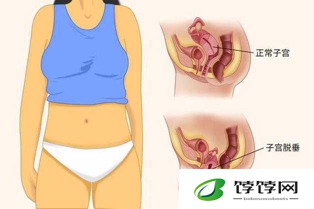女性得阴挺病是怎么回事：震惊！女性阴挺病的真相与应对策略