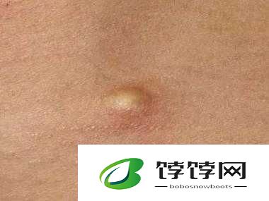 女子胸前莫名长俩疙瘩：病因成谜